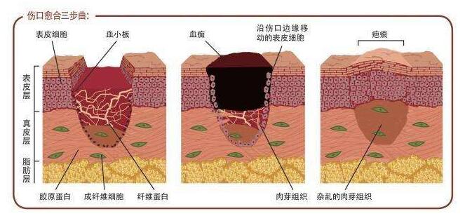 傷口難愈合是什么原因，如何解決